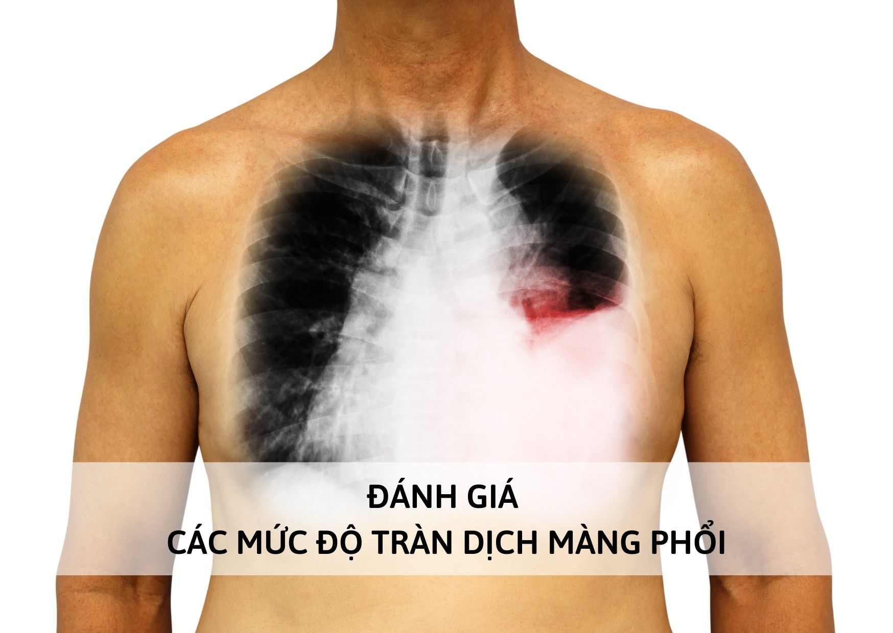 Đánh giá mức độ tràn dịch màng phổi và phương pháp điều trị bệnh