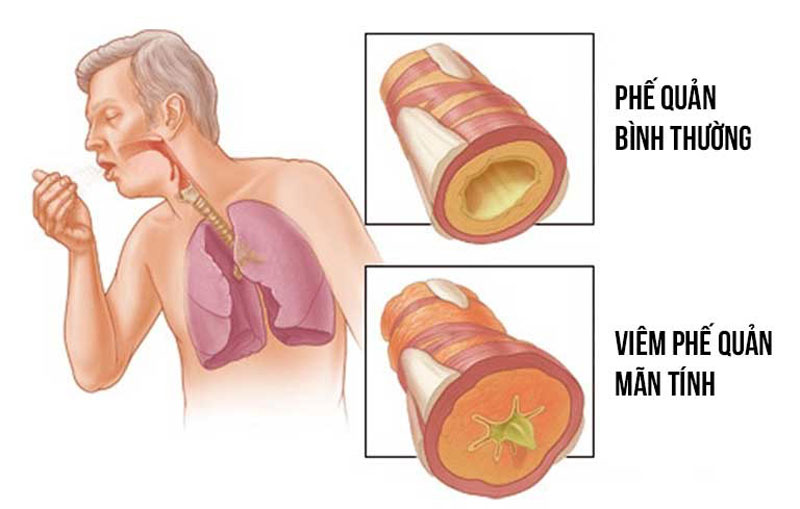 Viêm phế quản có thể gây tử vong, điều mà ít người nghĩ đến!