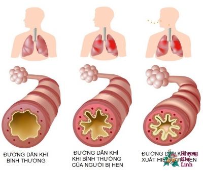 Bệnh hen suyễn uống thuốc gì? Bệnh có thể chữa khỏi được không?