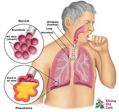 Ho có đờm vàng lâu ngày không khỏi cảnh báo bạn đang mắc bệnh gì? Cách chữa bệnh theo dân gian an toàn và hiệu quả.