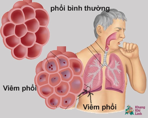 nguyen-nhan-viem-phoi