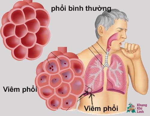 benh-viem-phoi-nhe-o-nguoi-cao-tuoi