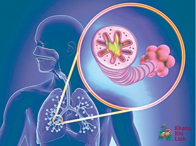 Viêm phế quản phổi ở người lớn có nguy hiểm không?